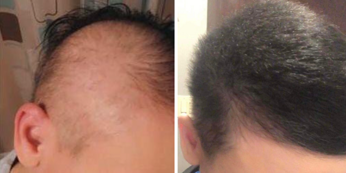 Alopecia Patient brings hair ‘back to life’