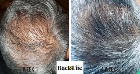 Back2Life Groluxe Advanced Hair Stimulation Oil Before & After Results