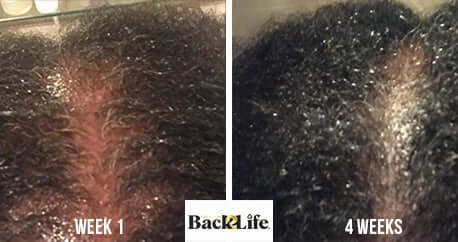 Back2Life Groluxe Advanced Hair Stimulation Oil Before & After Results